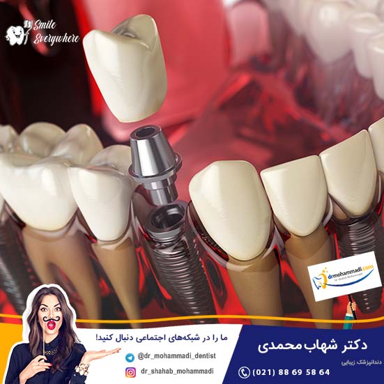 ایمپلنت دندان چه تاثیری در پیشگیری از تحلیل استخوان فک دارد؟ - کلینیک دندانپزشکی دکتر شهاب محمدی